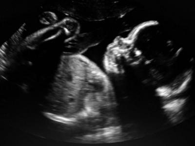 Izvršila ABORTUS u kućnim uslovima: Zahvaljujući specifičnoj trudnoći DESEILO se nešto NEVEROVATNO!
