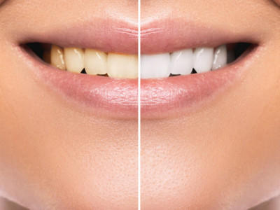 Izbelite zube na PRIRODAN način: Pomešajte ova ČETIRI sastojka iz kuhinje i uživajte u SNEŽNO belom osmehu