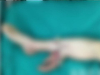 Najbizarnija operacija u ISTORIJI: Muškarac je PODLETEO pod cirkular koji mu je OTKINUO ruku, hirurg mu je zašio ŠAKU za NOGU