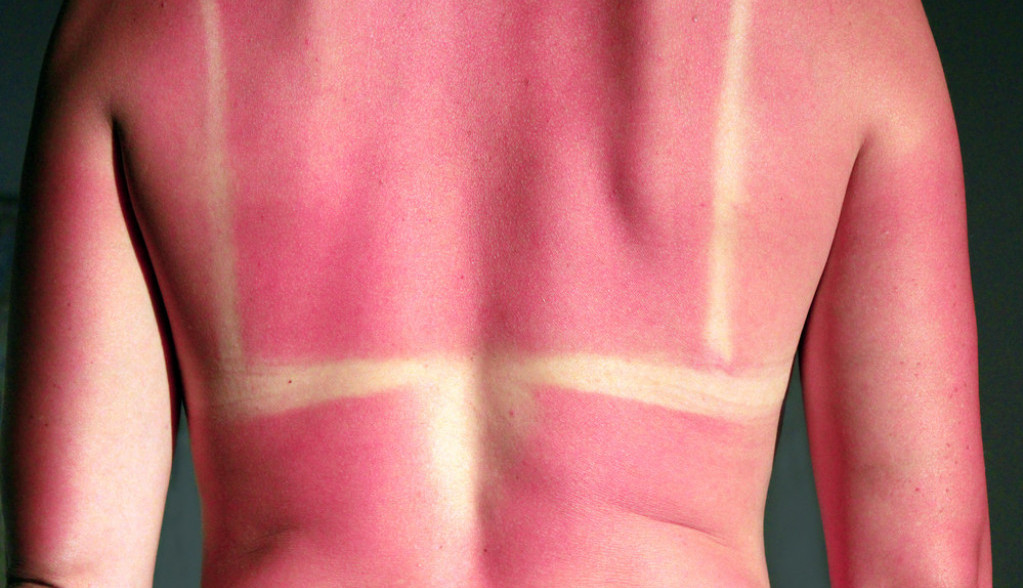 Dermatolozi otkrili: Ovo su NAJBOLJI kućni lekovi za opekotine od sunca