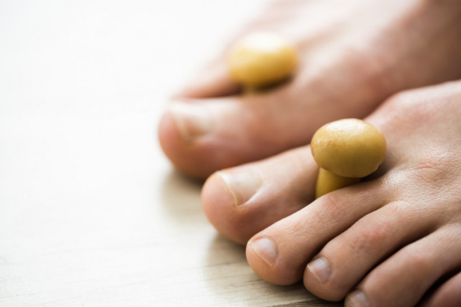 Gljivice na noktima mogu ozbiljno narušiti zdravlje: Ova tri domaća leka uspešno suzbijaju infekciju! (RECEPT)