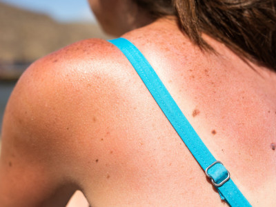 Alergija na sunce: Simptomi mogu da budu veoma neprijatni, evo ko je najugroženiji i kako da se zaštitite