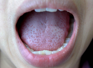 Ove simptome morate da shvatite ozbiljno: Ako vam TRNE jezik, HITNO kod lekara!
