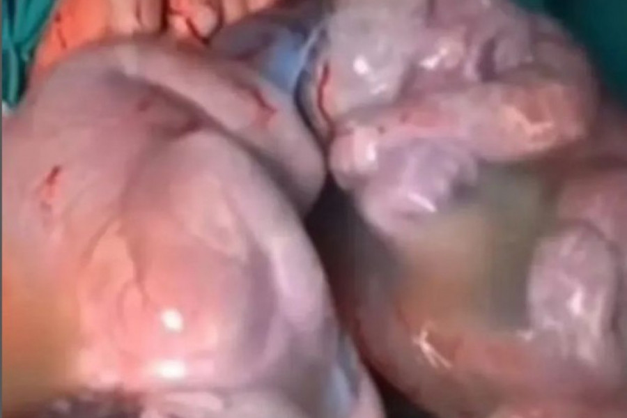 Svet gleda u ČUDU ovaj snimak: Doktor uspeo da SNIMI rađanje BLIZANACA, ovo se dešava JEDNOM u 80.000 slučajeva