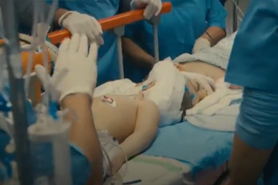 Glave su im bile SPOJENE: Nakon više od 25 sati na operacionom stolu, lekari su uspeli da razdvoje SIJAMSKE blizance (VIDEO)