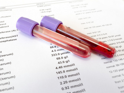 Običan pregled može da vam produži život: Izvadite krv i proverite ove brojke