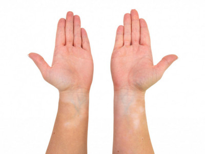 Dobro pogledajte u dlan: Ako na koži primetite ovo, gvožđe vam je kritično nisko i preti vam anemija