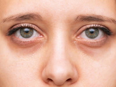 Povišen holesterol se vidi u očima: Dr Bajić upozorava kako da uočite prve simptome bolesti koju zovu i "tihi ubica"