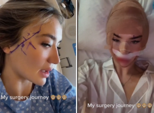 Otišla je u Tursku na plastičnu operaciju: Nastao je HAOS nakon što je skinula  zavoje sa glave