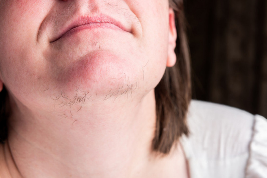 Šta dlačice na bradi govore o zdravlju žene? Umesto da ih čupate, idite brzo kod lekara