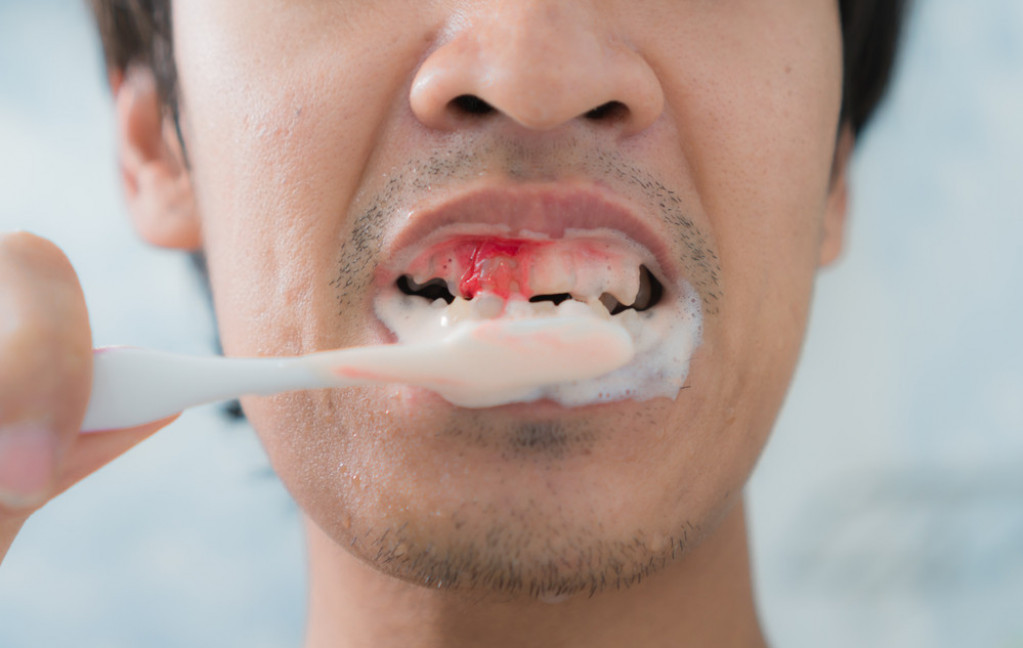 Desni vam KRVARE pri pranju zuba? Postoji jedan metod kojim se ublažava tegoba