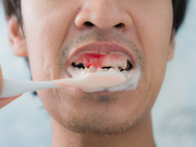 Ovakvo stanje je ZABRINJAVAJUĆE: Ako vam je beo jezik, desni krvare i loš zadah, hitno na pregled