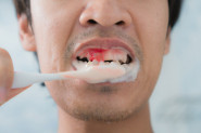 Ovakvo stanje je ZABRINJAVAJUĆE: Ako vam je beo jezik, desni krvare i loš zadah, hitno na pregled
