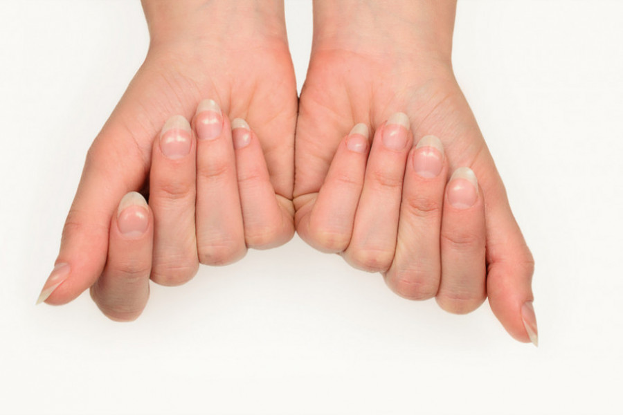 Šta znače bele mrlje na vašim noktima? Evo kada treba da se zabrinete