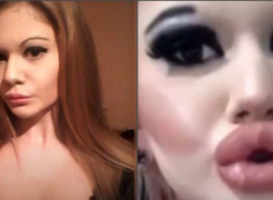 Andrea ima najveće USNE na svetu, a želi REKORDNO VELIKE grudi: Ona ima samo 23 godine, a zbog operacija je umalo OSLEPELA!