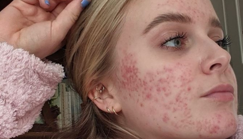 Zbog pilule za kontracepciju celo lice je BOLI: Već dve godine vodi bitku sa AKNAMA, a dermatolozi nemaju LEK za nju