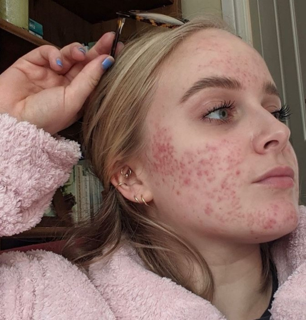 Kako da se ŠMINKATE ako imate AKNE: Dermatolozi otkrili šta je najvažnije, jednu GREŠKU SA PUDEROM svi prave
