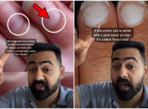 Doktor Rej apeluje: Ako vam OVAKO izgledaju NOKTI onda možda patite od ozbiljne BOLESTI
