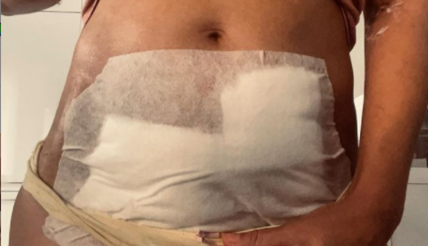 "Puna sam ožiljaka, konaca, trauma": Dariji su u bolnici u BARU uklonili plod CARSKIM REZOM u 13. nedelji, a naš GINEKOLOG objašnjava kada se i zašto radi ovaj ZAHVAT