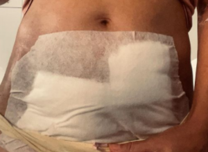 "Puna sam ožiljaka, konaca, trauma": Dariji su u bolnici u BARU uklonili plod CARSKIM REZOM u 13. nedelji, a naš GINEKOLOG objašnjava kada se i zašto radi ovaj ZAHVAT