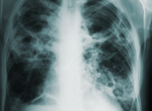 Alternativna medicina je rešenje brzog oporavka: Ove ČETIRI BILJKE su ključne u vašim problemima sa PLUĆIMA