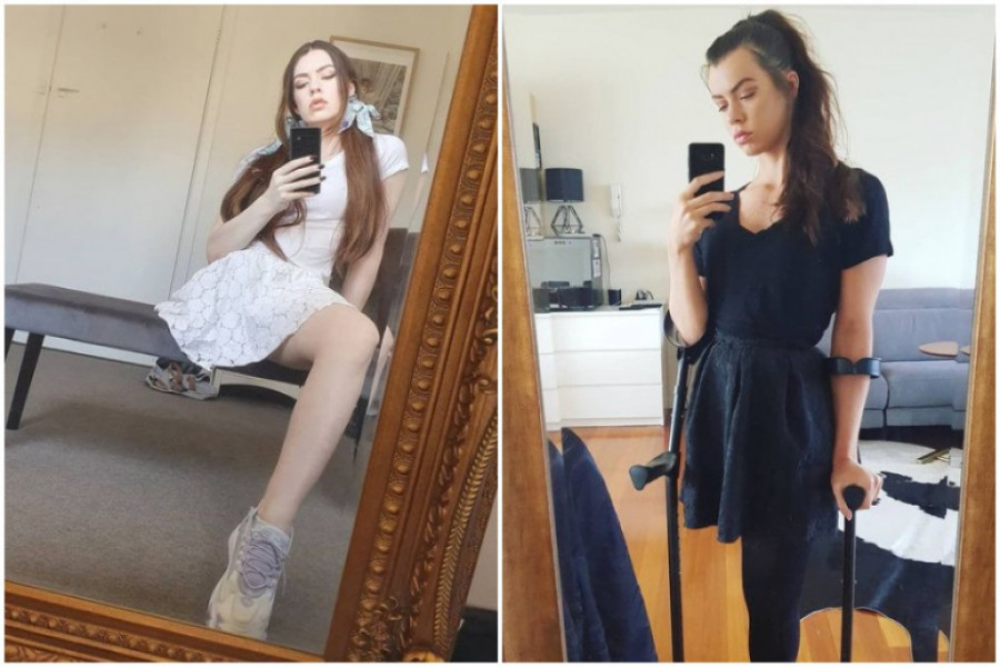 Zbog TUMORA je ostala bez NOGE: Danas je SUPER MODEL, a evo zašto je svi nazivaju LAŽLJIVICOM