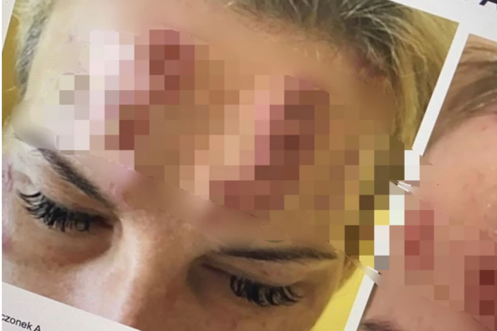 Kineski BOTOKS stigao u SRBIJU: Deluje kao PRAVI, ali mnogo jeftiniji, doktorka UPOZORILA i o posledicama koje su FATALNE (UZNEMIRUJUĆE FOTOGRAFIJE)