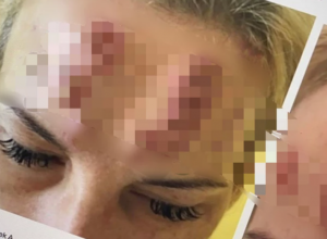 Kineski BOTOKS stigao u SRBIJU: Deluje kao PRAVI, ali mnogo jeftiniji, doktorka UPOZORILA i o posledicama koje su FATALNE (UZNEMIRUJUĆE FOTOGRAFIJE)