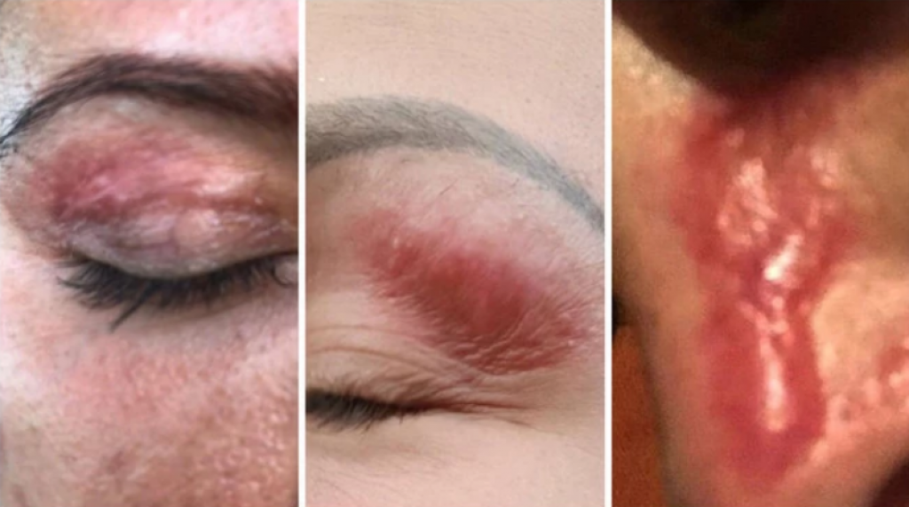 OŽILJCI o kojima i sada bruji Srbija: Dr Borić obrašnjava ZAŠTO su žene SPALJENE "Plasma pen" tretmanom i šta je ključno da vas NE PREVARE