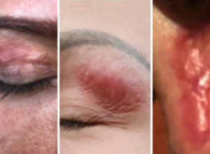 OŽILJCI o kojima i sada bruji Srbija: Dr Borić obrašnjava ZAŠTO su žene SPALJENE "Plasma pen" tretmanom i šta je ključno da vas NE PREVARE