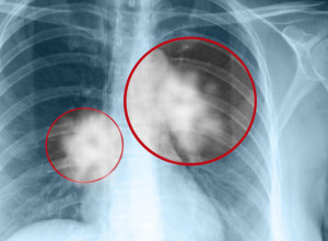 Zašto neki pušači NIKADA ne obole od RAKA PLUĆA: Lekari su konačno dali OBJAŠNJENJE, a jedna stvar je KLJUČNA kod nastanka ove BOLESTI