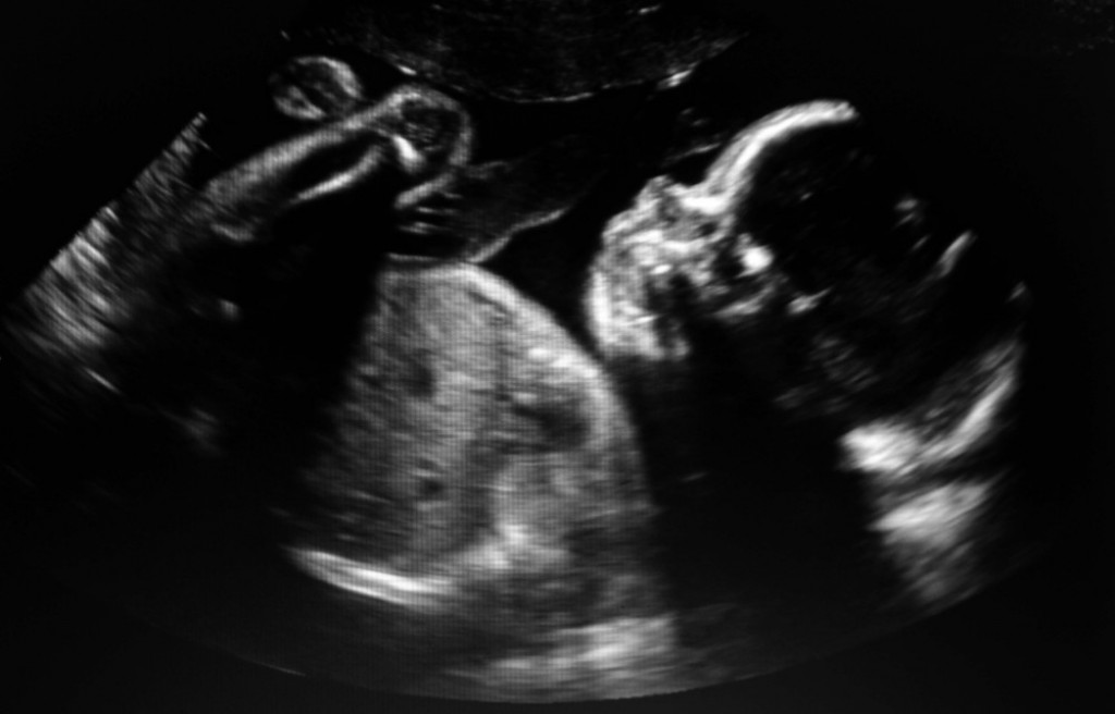 Izvršila ABORTUS u kućnim uslovima: Zahvaljujući specifičnoj trudnoći DESEILO se nešto NEVEROVATNO!