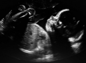 Izvršila ABORTUS u kućnim uslovima: Zahvaljujući specifičnoj trudnoći DESEILO se nešto NEVEROVATNO!