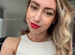 Da li je PSORIJAZA prenosna? Devojka koja pati od ove kožne bolesti daje odgovor na ovo pitanje