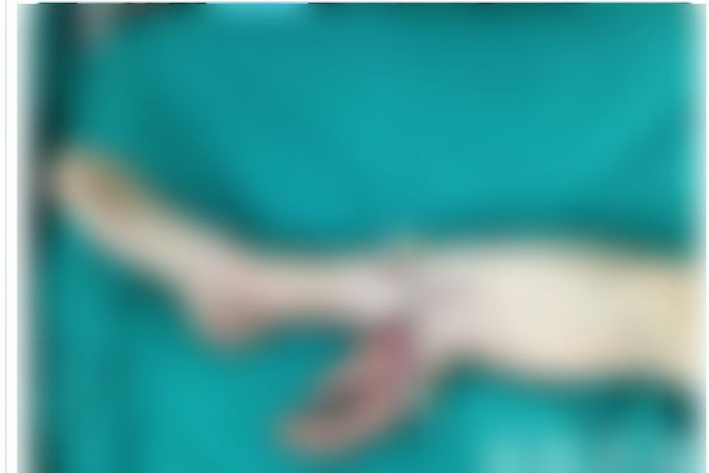 Najbizarnija operacija u ISTORIJI: Muškarac je PODLETEO pod cirkular koji mu je OTKINUO ruku, hirurg mu je zašio ŠAKU za NOGU