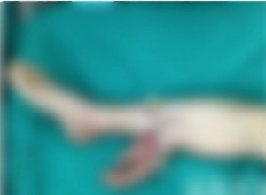 Najbizarnija operacija u ISTORIJI: Muškarac je PODLETEO pod cirkular koji mu je OTKINUO ruku, hirurg mu je zašio ŠAKU za NOGU