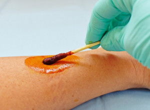 Na ruku namažite JOD i posmatrajte kako se ponaša MRLJA: Ovim jednostavnim testom ćete UTVRDITI u kakvom je stanju vaša ŠTITASTA ŽLEZDA