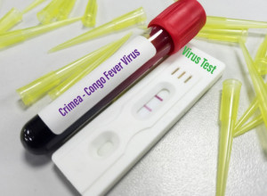 Britanci u strahu od nove EPIDEMIJE: Žena obolela od smrtonosnog VIRUSA nalik EBOLI - ovo su simptomi!