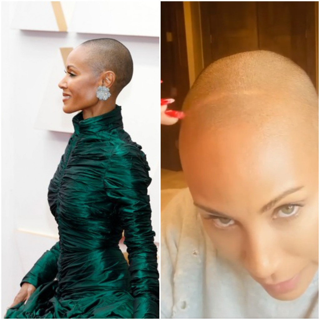 Rok je UVREDIO ženu Vila Smita zbog ALOPECIJE: Ona može da pogodi BILO KOJI deo tela, a evo kako da se prepozna NA VREME