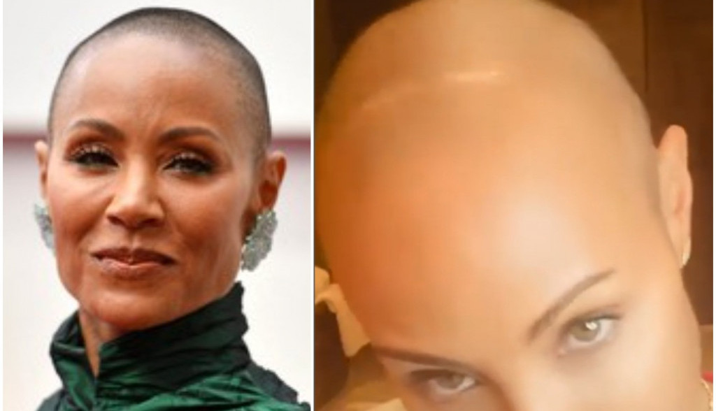 Rok je UVREDIO ženu Vila Smita zbog ALOPECIJE: Ona može da pogodi BILO KOJI deo tela, a evo kako da se prepozna NA VREME