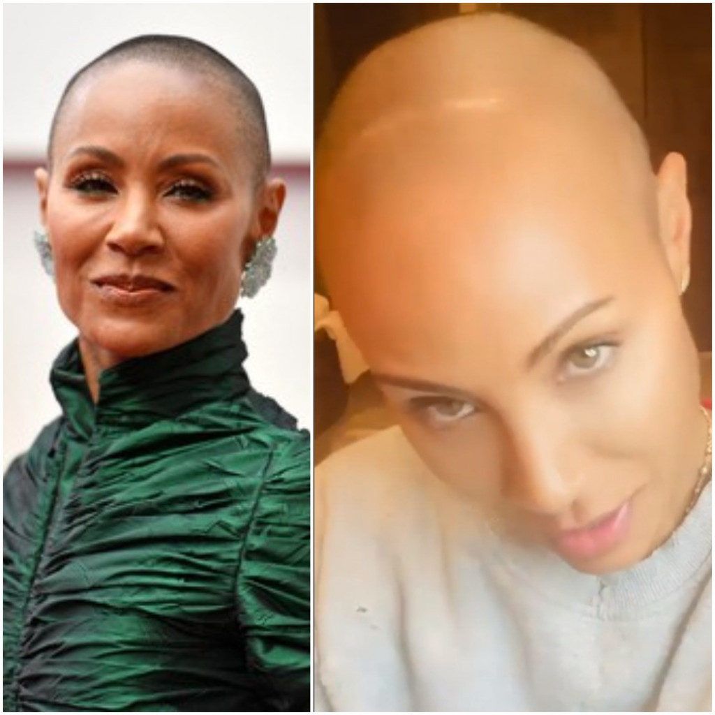 Rok je UVREDIO ženu Vila Smita zbog ALOPECIJE: Ona može da pogodi BILO KOJI deo tela, a evo kako da se prepozna NA VREME