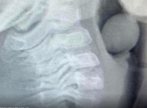 DEČAK (6) završio u HITNOJ: Šokantan rendgenski snimak pokazuje šta je progutao i počeo da se GUŠI