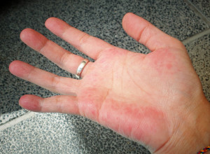 Uradite brzi test i saznajte da li bolujete od ANEMIJE: Ako vidite ovu promenu na DLANU odmah se obratite LEKARU