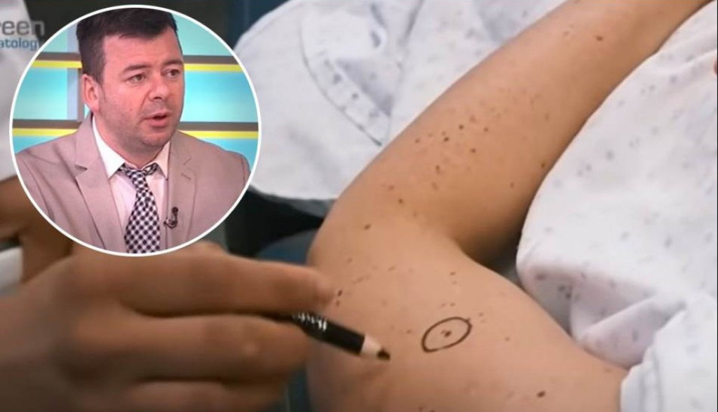 Dermatolog otkrio koji su NAJOPASNIJI mladeži: Evo koje NE TREBA dirati i koje HITNO treba da UKLONITE