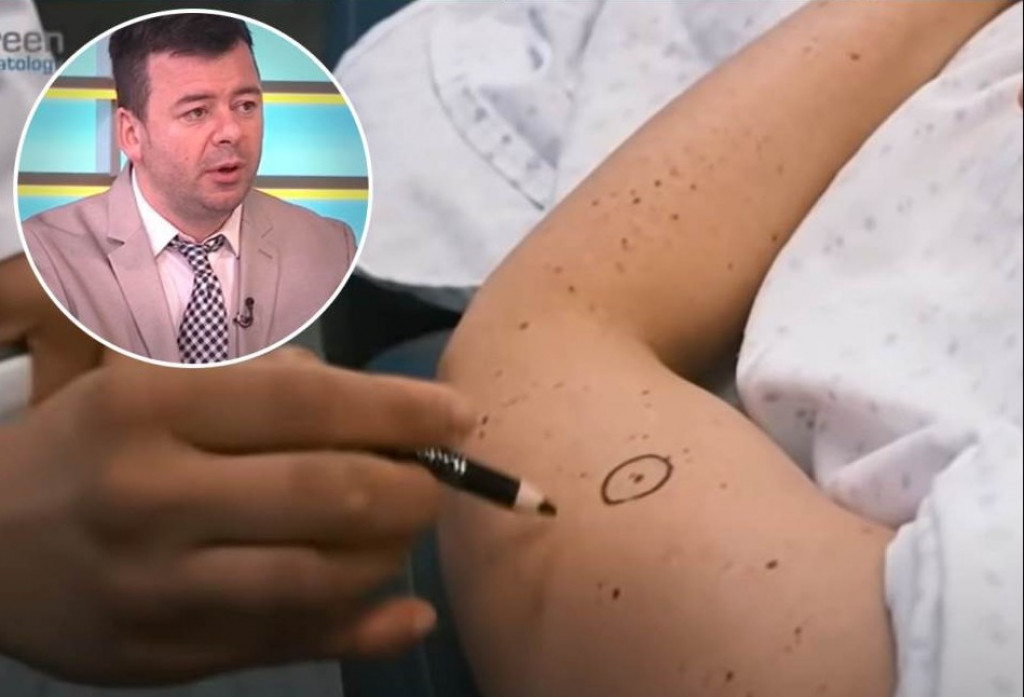 Dermatolog otkrio koji su NAJOPASNIJI mladeži: Evo koje NE TREBA dirati i koje HITNO treba da UKLONITE