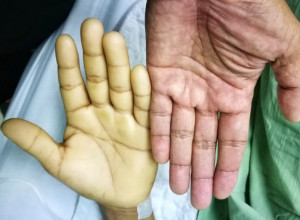 Ove simptome ni za ŽIVU GLAVU ne ignorišite: Tiha ANEMIJA razara organizam, posledice mogu biti OPASNE