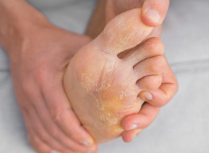 Pravi spas od ISPUCALE i SUVE kože na stopalima: "Namazala sam JEDAN sastojak na GRUBE PETE i ostala u čudu, noge su mi bile premekane"