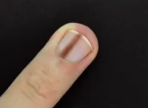 Ako na noktu imate ovakvu liniju, odmah idite kod doktora: Ne odlažite posetu, može biti MELANOM!