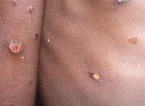 MAJMUNSKE BOGINJE STIGLE I KOD KOMŠIJA: Pacijent u kućnoj izolaciji