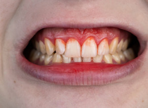 Krvare vam DESNI, bole vas ZGLOBOVI i gojite se: Ako imate ove simptome fali vam jedan od najvažnijih VITAMINA!